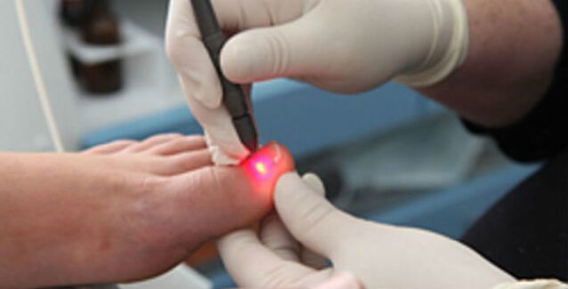 Oinetako iltze onddoetarako laser terapia